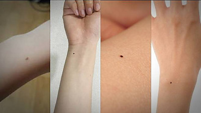여자들은 전부 손목에 까만 점이 있다는데 사실일까?